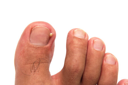 Can Tight Shoes Cause Ingrown Toenails